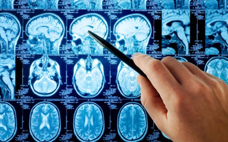 embolio-auksanei-ta-pososta-epibiosis-se-astheneis-me-ogko-ston-egkefalo