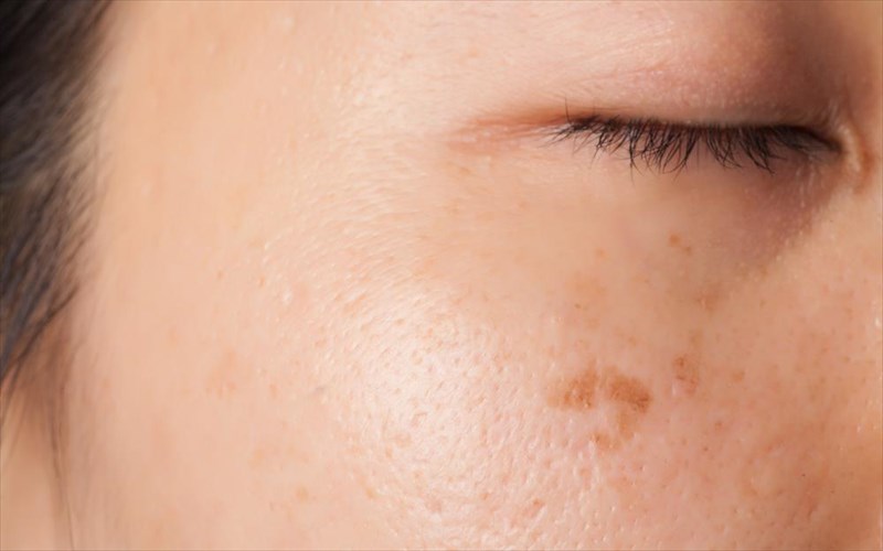 panades-dusxromies-kai-pos-na-tis-antimetopisete